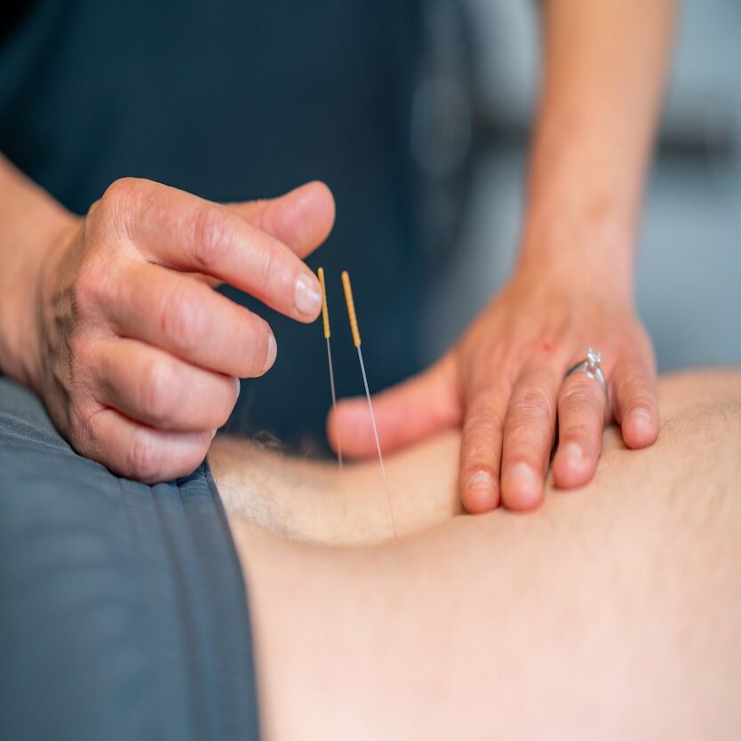 physiotherapy dry needling